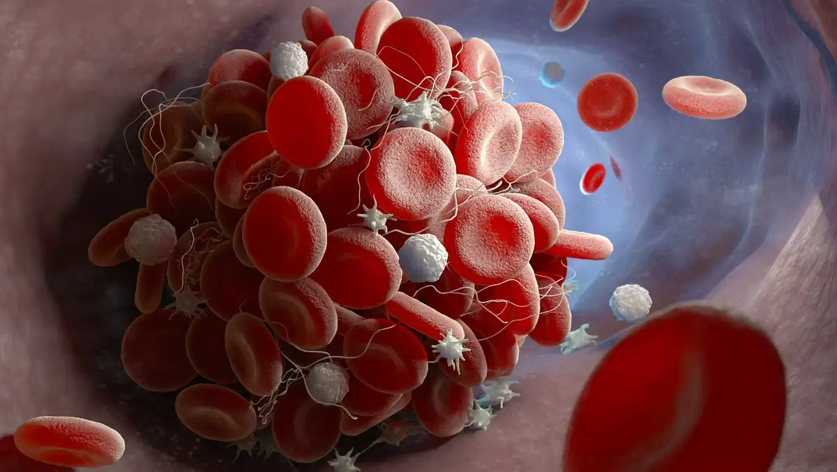 Ursache für Blutgerinnsel nach COVID-Impfung identifiziert