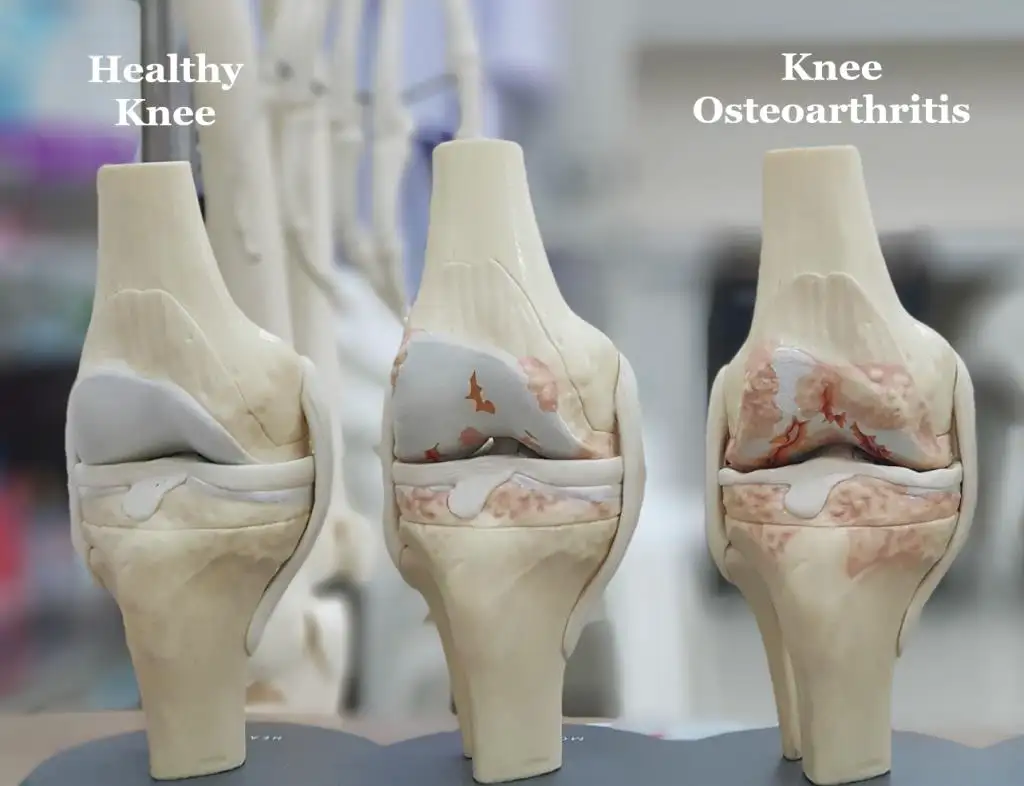 Arthrose: Neue Ein-Injektions-Therapie als Hoffnung